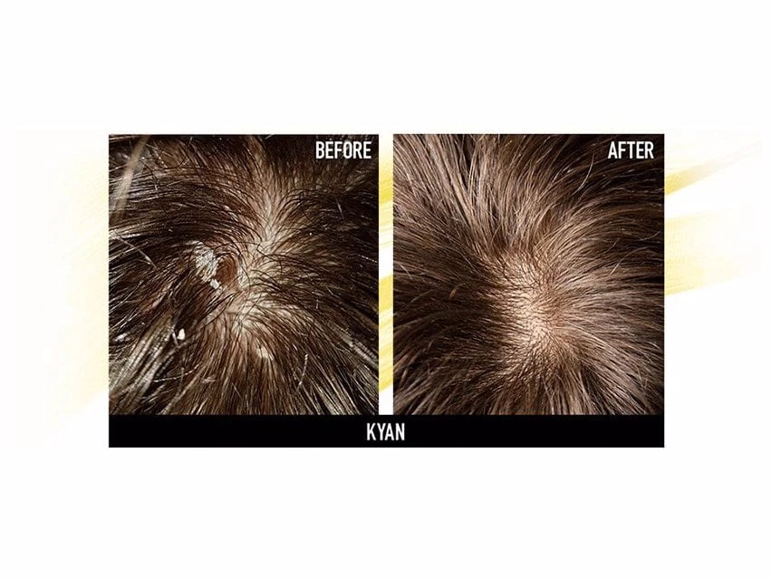 Hairsanity Anti-Dandruff Conditioner 5 Hairsanity Anti-Dandruff Conditioner - Image 5